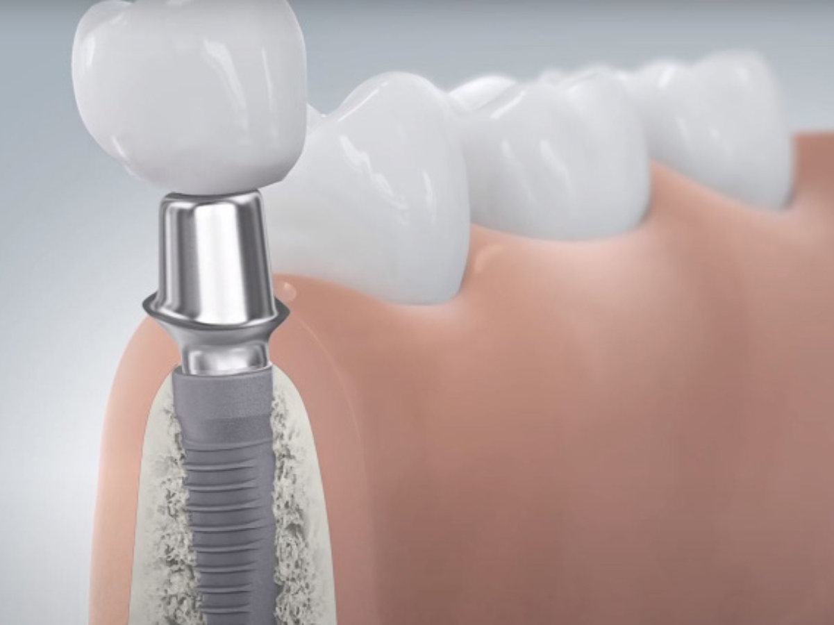 Querschnitt eines Unterkiefermodells, veranschaulicht wird wie das Zwischenstück (Abutment) in das Implantat eingesetzt wird, um die Krone darauf zu befestigen.