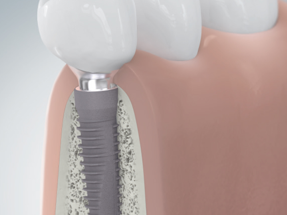 Querschnitt eines Unterkiefermodells mit einer definitiven Implantatversorgung beispielhaft für eine Einzelzahnrekonstruktion.