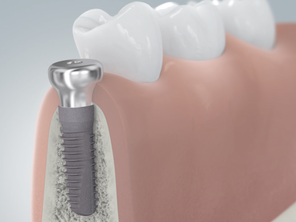 Querschnitt eines Unterkiefermodells, veranschaulicht wird wie durch einen Gingivaformer das Zahnfleisch für die spätere Zahnkrone ausgeformt wird um ein natürlich wirkendes Behandlungsergebnis zu erzielen.