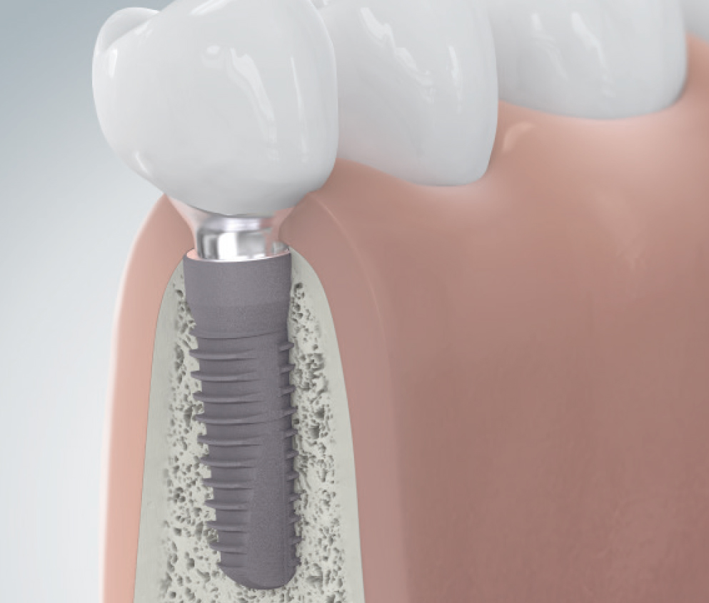 Querschnitt eines Unterkiefermodells mit einer definitiven Implantatversorgung beispielhaft für eine Einzelzahnrekonstruktion.