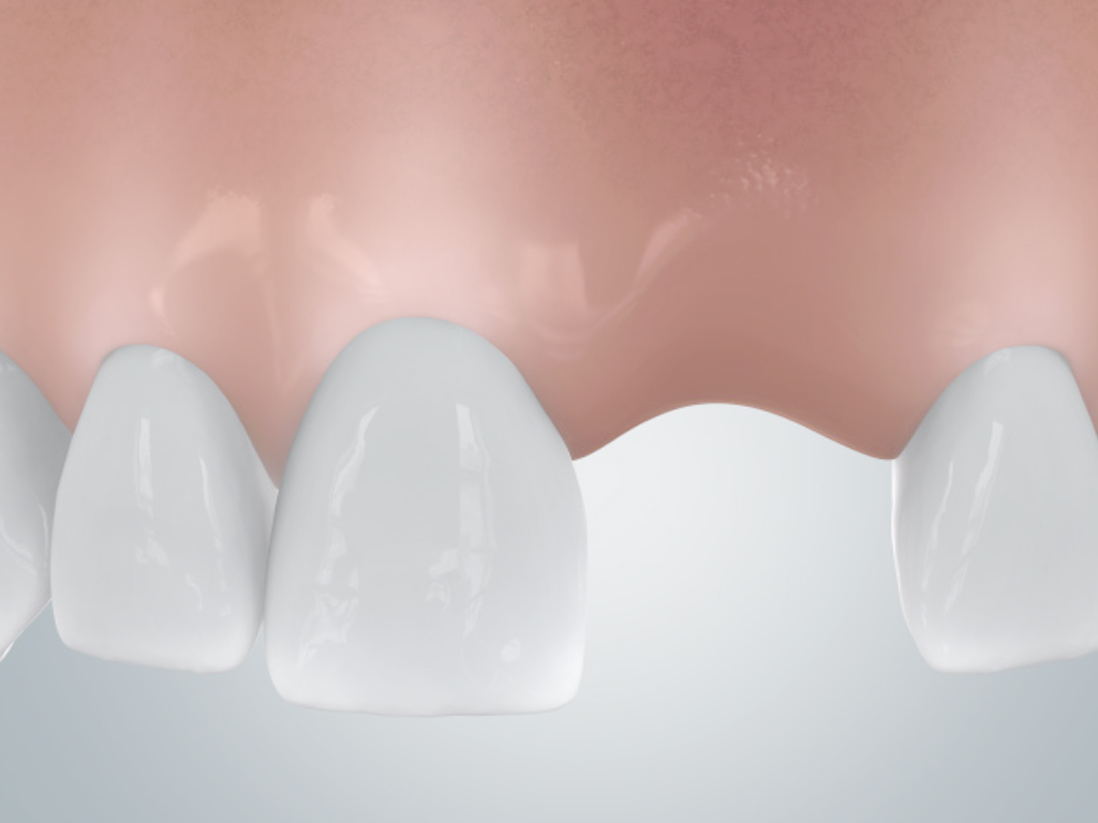 Darstellung eine Schaumodells des Oberkiefers, dabei eine Lücke im Frontzahnbereich veranschaulicht.