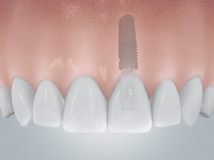 Darstellung eine Schaumodells des Oberkiefers, dabei eine Einzelzahnversorgung durch ein Zahnimplantat im Frontzahnbereich veranschaulicht.