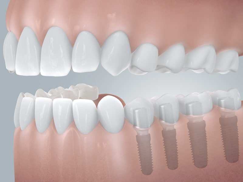 Seitliche Darstellung eine Schaumodells des Unter- und Oberkiefers, dabei wird veranschaulicht wie ein Schaltlücke im Unterkiefer durch 4 Implantate geschlossen werden kann.