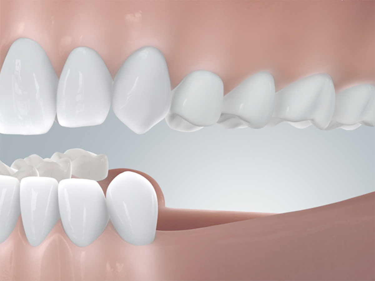 Seitliche Darstellung eine Schaumodells des Unter- und Oberkiefers, dabei wird veranschaulicht wie eine Freiendlücke vor der Zahnimplantation aussieht.