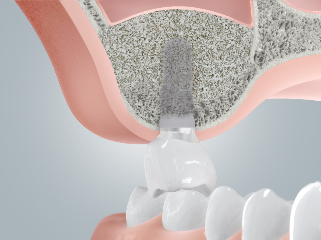 Schaumodell Sinuslift mit Implantatversorgung