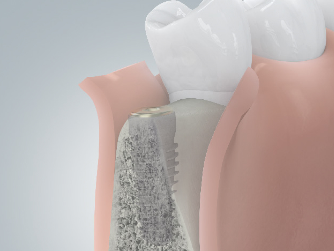 Schaumodell wie bei geringem Knochenabbau der Knochenaufbau gleichzeitig zur Implantation erfolgen kann.