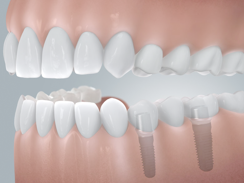 Seitliche Darstellung eine Schaumodells des Unter- und Oberkiefers, dabei wird veranschaulicht wie ein Schaltlücke im Unterkiefer durch 2 Implantate und einer Brückenversorgung geschlossen werden kann.