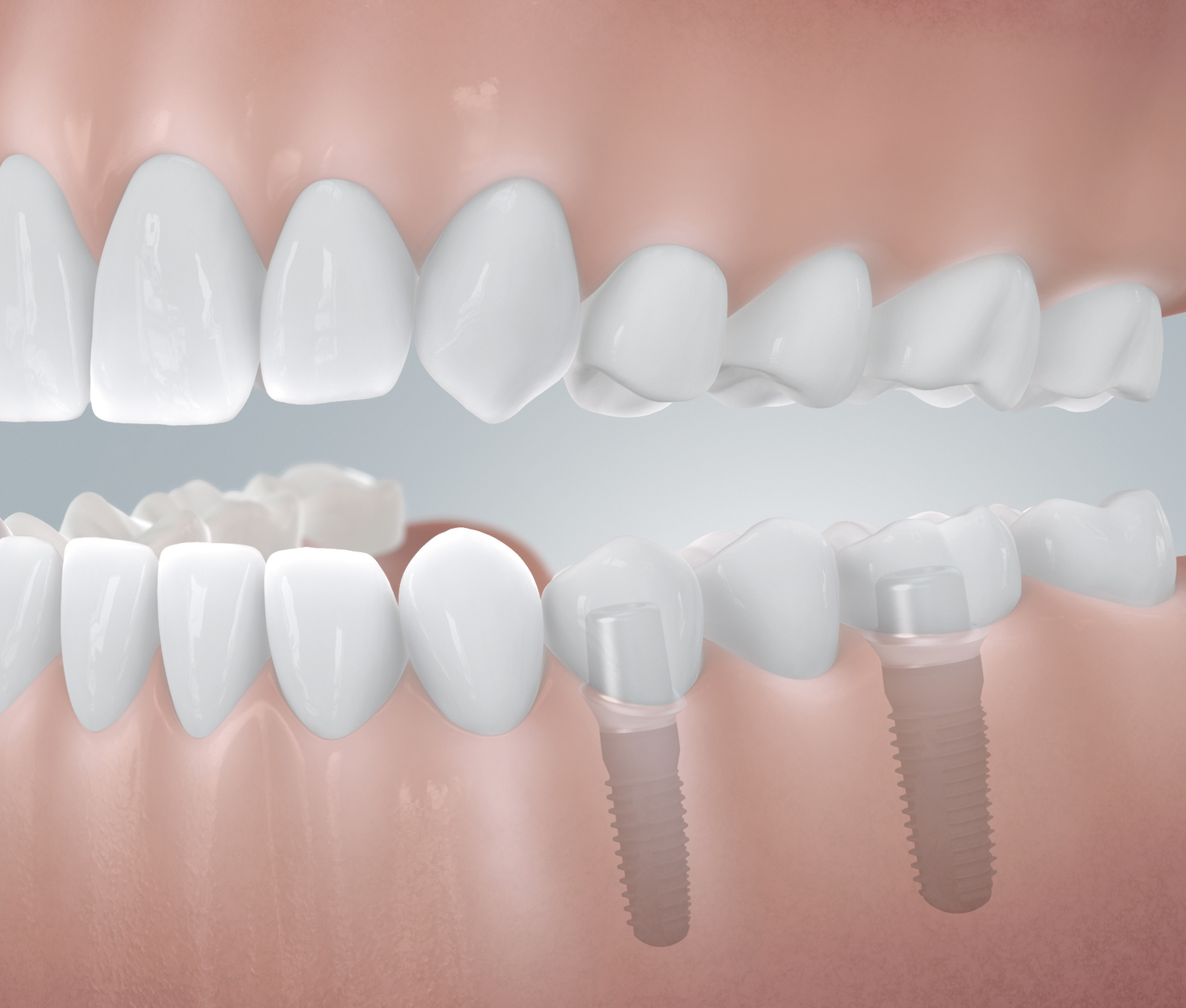 Seitliche Darstellung eines Kiefers, in dem eine Schaltbrücke durch 2 inserierte Implantate getragen wird.