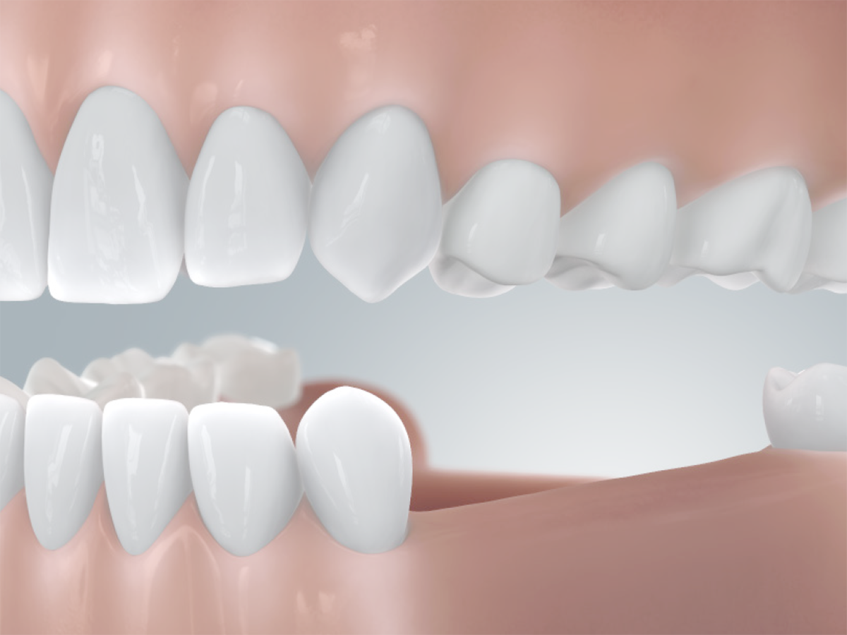 Seitliche Darstellung eine Schaumodells des Unter- und Oberkiefers, dabei wird veranschaulicht wie ein Schaltlücke vor der Zahnimplantation aussieht.