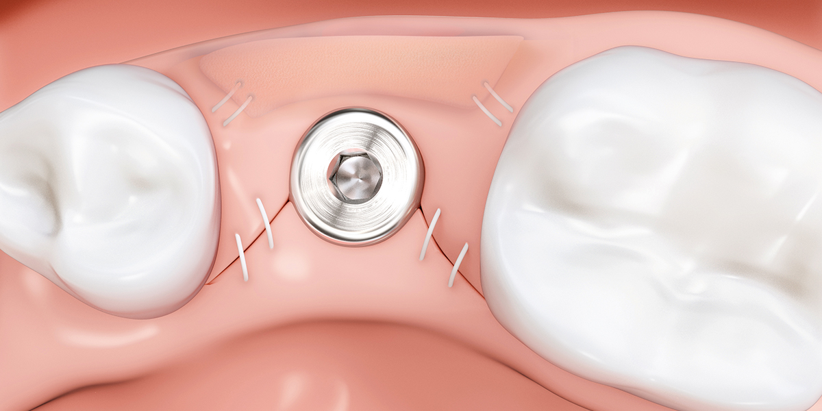 Darstellung der
Weichgewebeverdickung um Implantate
nach der Implantatinsertion.